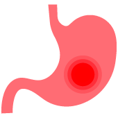 gastro-debora-poli-hemorragia-digestiva